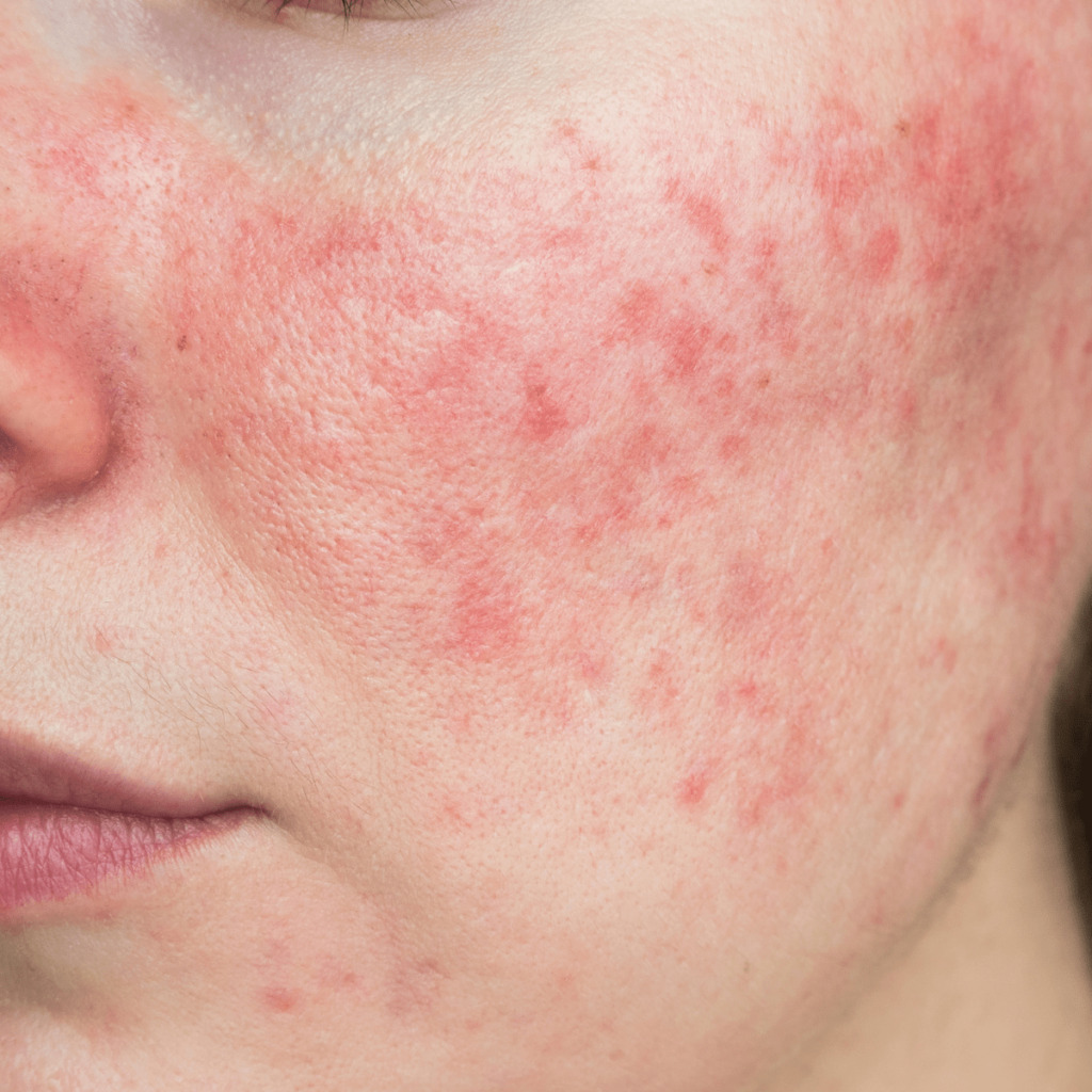 Close up of woman with rosacea on cheek