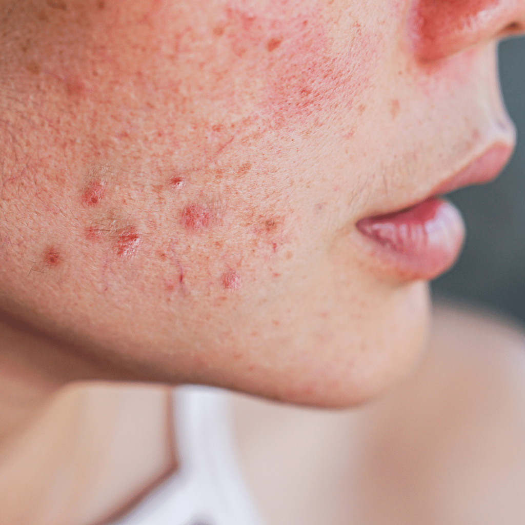 Close up of face with acne spots