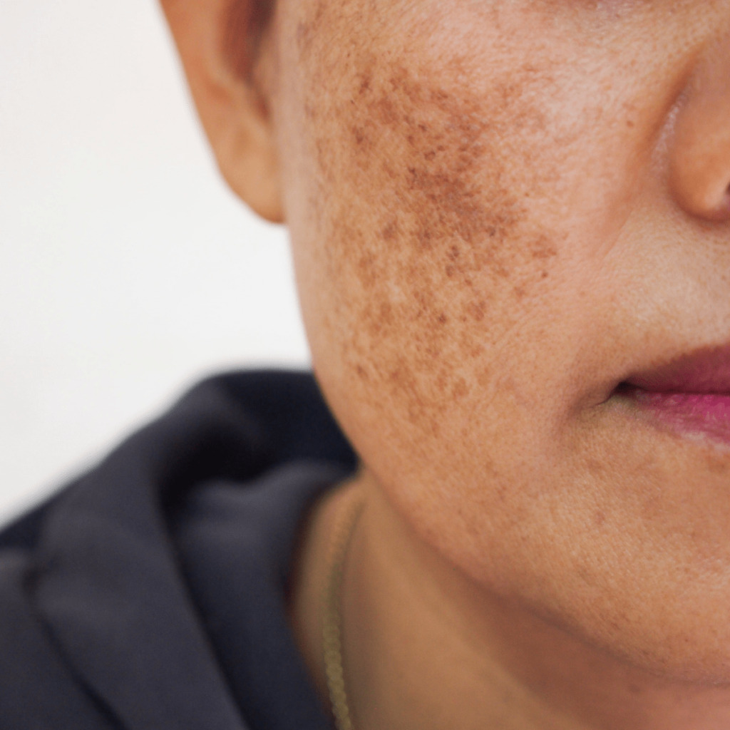 Close up of face with pigmentation