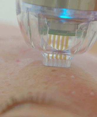 microneedling process for getting a soft skin