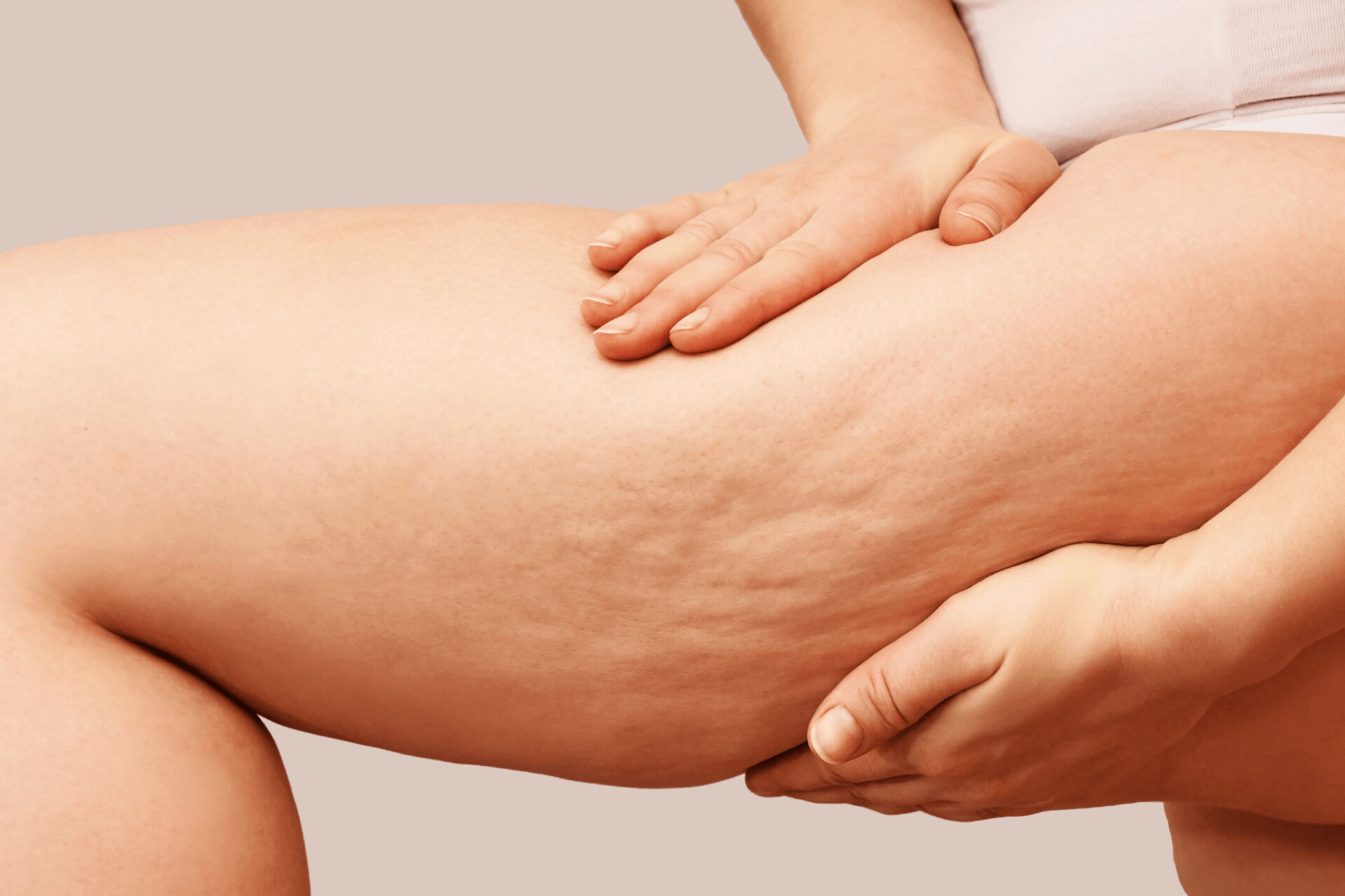 close up of womans thigh with cellulite stretch marks
