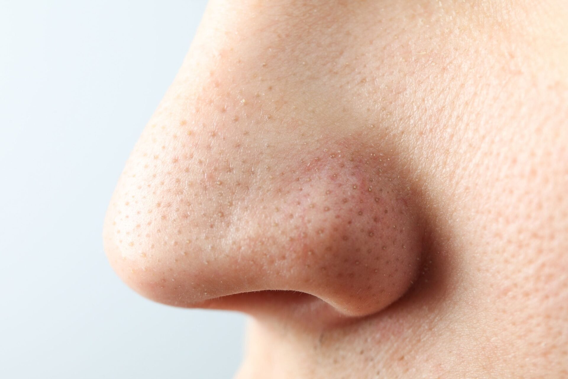 Zoomed in to nose highlighting pores