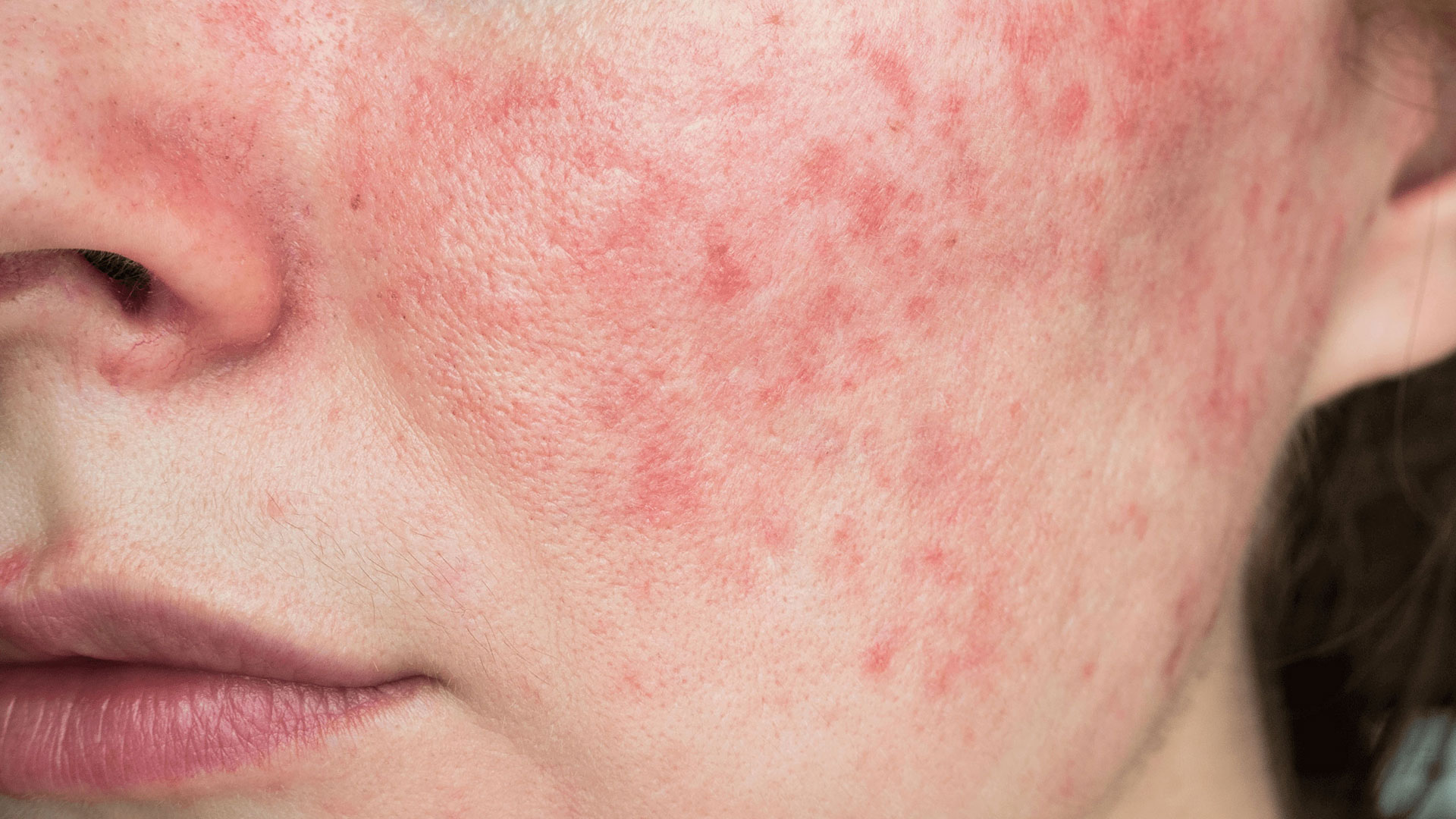zoomed in image of pale womans face highlting rosacea
