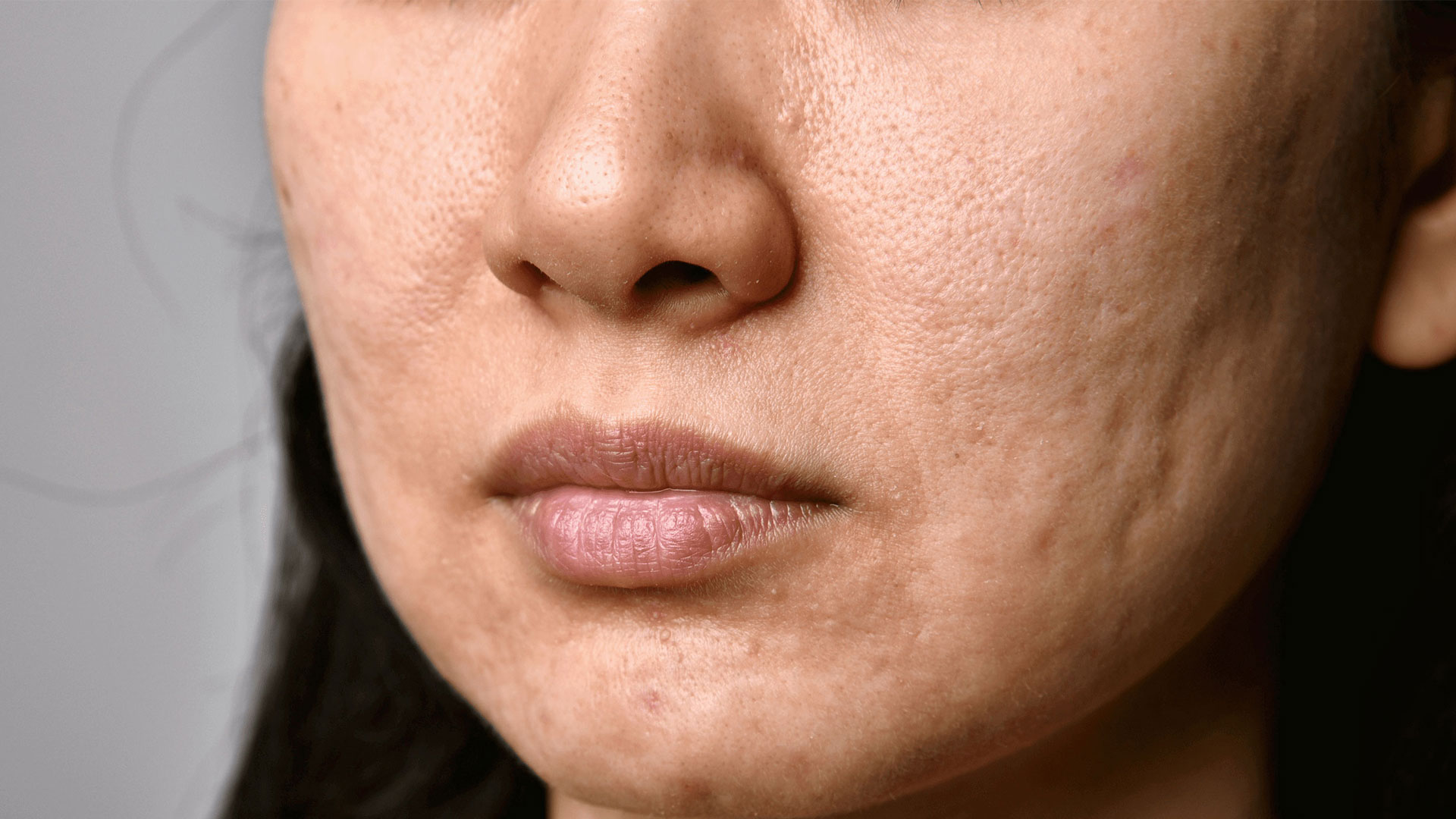Close up of asian womans face, highlighting scarring