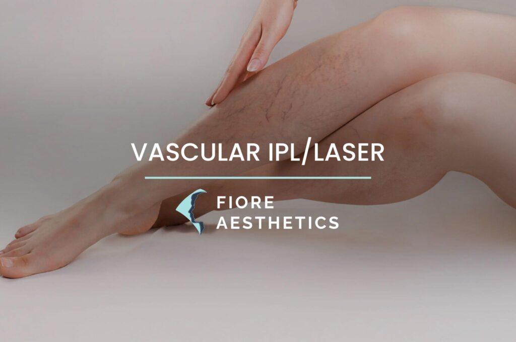 Vascular IPL Laser Treatment London