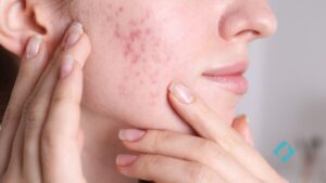 close-up of a woman's cheek with visible acne scars