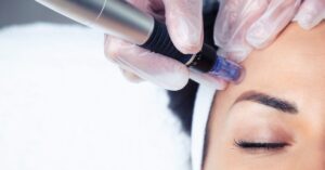 an image of a woman having a RF microneedling procedure