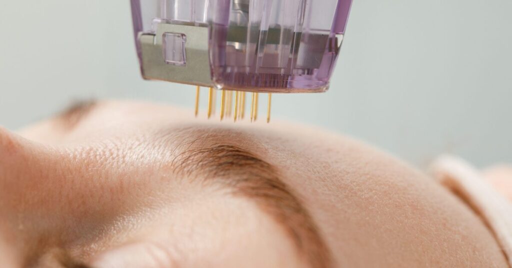 What Is The Buzz About This Celebrity-Favourite Skin Fix? A close up image of a RF microneedling device
